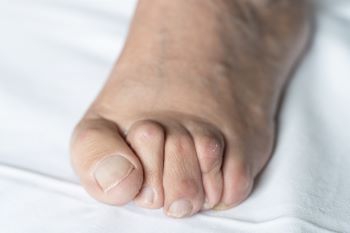 Hammer Toe